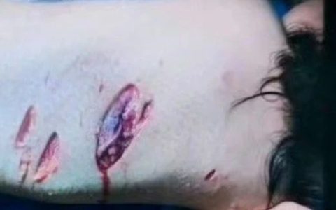 狗咬裂2岁女童肾脏可辩称为无意，但放狗出门肯定是故意